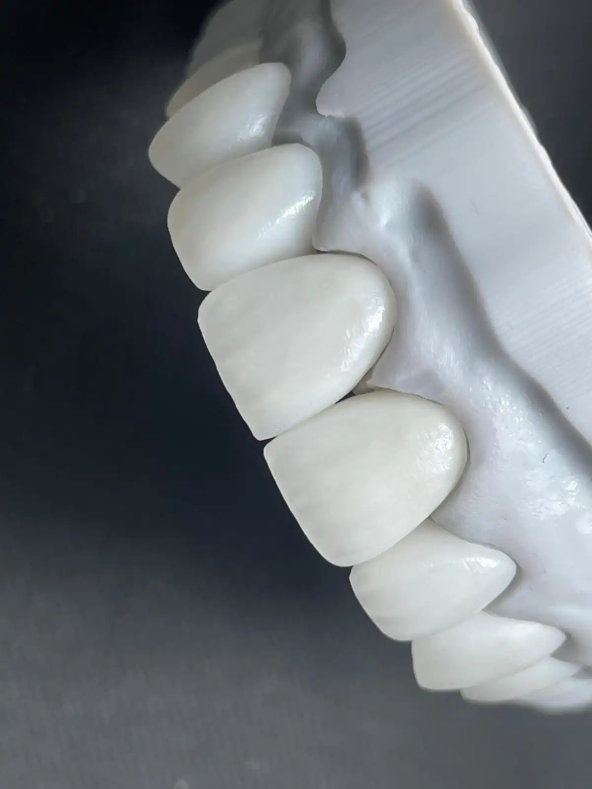 prothese conjoint Prothese conjointe